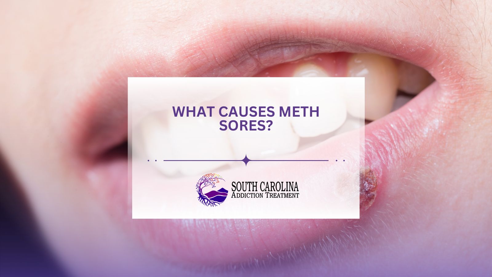 What Causes Meth Sores?