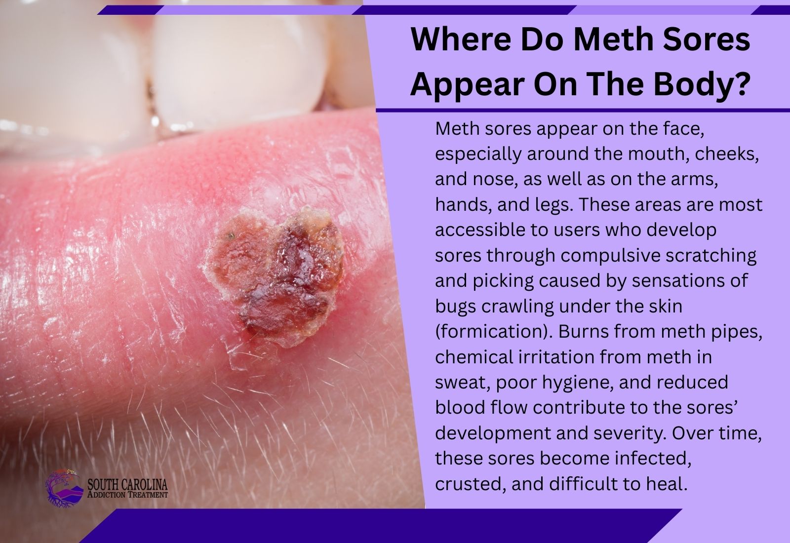 Where Do Meth Sores Appear On The Body